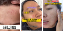 請勿使用痘痘/斑點成團成簇影響用戶體驗的素材設計，如【視頻中展現痘痘點形象泛紅成簇、斑點密集場景】，請修改裂起皮、起屑、輕微干裂傷口等影響用戶體驗的素材設計，如【視頻中展現干裂起皮、起屑場景】，請修改